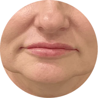 Jawline firmness