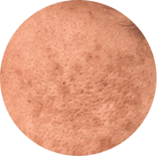 Dull skin